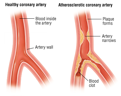 healthy artery vs clotted artery