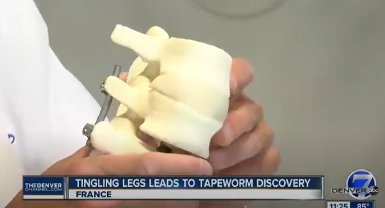 BCH Health Segment: Alternatives to Spinal Fusion for Back Pain Thumbnail