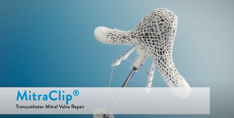 MitraClip Procedure Animation Video Thumbnail