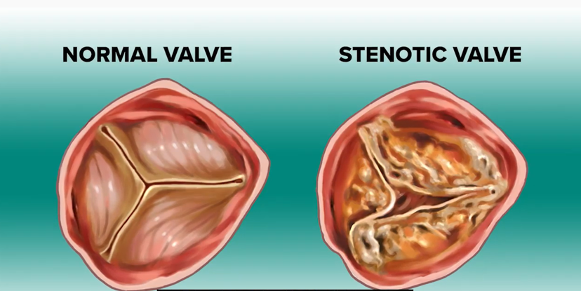 TAVR: Jim & Sarah’s Stories Thumbnail